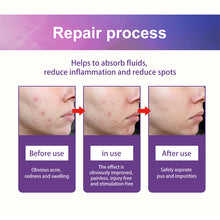 Load image into Gallery viewer, Colorful Acne Patches Fade Spots Acne Hydrogel Patches Repair Facial Acne Defects Skin Care Beauty Health