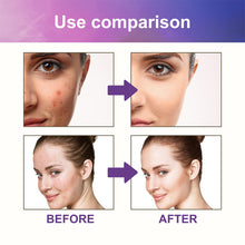 Load image into Gallery viewer, Colorful Acne Patches Fade Spots Acne Hydrogel Patches Repair Facial Acne Defects Skin Care Beauty Health