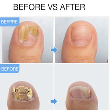 Load image into Gallery viewer, 20ml Nail Fungal Treatment Oil Feet Care Repair Essence Toe Nail Fungus Removal Gel Anti Infection Remedy Cream
