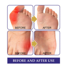 Load image into Gallery viewer, Anti Bunion Patch Anti Bursitis Patch for Correcting Swelling and Pain In The Feet, Thumb Eversion Patch Care Patch
