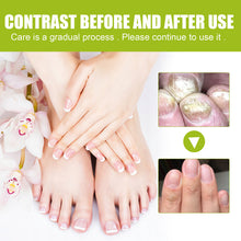 Load image into Gallery viewer, Nail Repair Gel Hand and Foot Nail Repair Soft Nail Thickening Nail Removing Nail Polish Repair Cream
