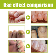 Load image into Gallery viewer, Nail Repair Gel Hand and Foot Nail Repair Soft Nail Thickening Nail Removing Nail Polish Repair Cream

