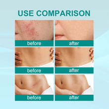 Load image into Gallery viewer, Scar Care Spray Fading Smoothing Surgical Scars Burn Scars Repairing Skin Scar Removal Spray Skin Care
