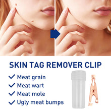 Load image into Gallery viewer, Wart Clamp Painless Warts Removal Clip Removing Warts Filamentous Warts Nevi Meatballs Skin Repair Skin Care
