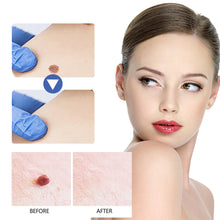 Load image into Gallery viewer, Wart Clamp Painless Warts Removal Clip Removing Warts Filamentous Warts Nevi Meatballs Skin Repair Skin Care
