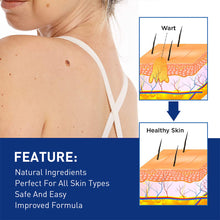 Load image into Gallery viewer, Wart Clamp Painless Warts Removal Clip Removing Warts Filamentous Warts Nevi Meatballs Skin Repair Skin Care
