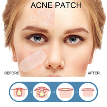 Load image into Gallery viewer, Hydrocolloid Acne Patches Waterproof Invisible Breathable Repair Acne Pimples Patches Fade Spots Acne Skin Care
