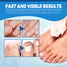 Load image into Gallery viewer, Nail Blue Light Laser Pen Onychomycosis Repair Laser Pen Restoring Nail Health Removing Odor Nail Care Tool
