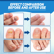 Load image into Gallery viewer, Nail Blue Light Laser Pen Onychomycosis Repair Laser Pen Restoring Nail Health Removing Odor Nail Care Tool
