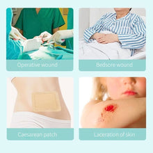 Load image into Gallery viewer, Self Adhesive Silicone Bedsore Patch Silicone Gel Foam Dressing for Elderly Hip Wound Polyurethane Foam Dressing Patches
