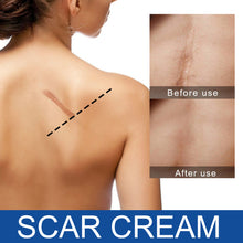 Load image into Gallery viewer, Skin Repair Cream Scar Cream Care for Scalds Burn Marks Acne Marks Fading and Smoothing Care Cream Scar Cream
