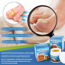 Load image into Gallery viewer, Nail Fungus Ointment Remove Paronychia Eliminate Ingrown Nail Moisturize Skin Repair Toenails Foot Care Cream Health Care
