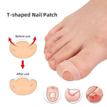 Load image into Gallery viewer, T-shaped Nail Sticker Ingrown Toenail Correction Patch Elastic Stretch Paronychia Inlaid Nail Restoration Patch Nail Care Tool
