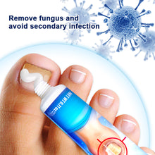 Load image into Gallery viewer, Mild Onychomycosis Cream Onychomycosis Care Repair Cream Toenail Onychomycosis Cream Nail Care Cream Health Care
