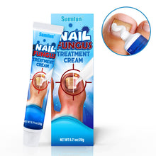 Load image into Gallery viewer, Mild Onychomycosis Cream Onychomycosis Care Repair Cream Toenail Onychomycosis Cream Nail Care Cream Health Care
