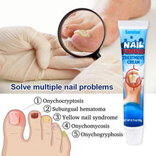 Load image into Gallery viewer, Mild Onychomycosis Cream Onychomycosis Care Repair Cream Toenail Onychomycosis Cream Nail Care Cream Health Care
