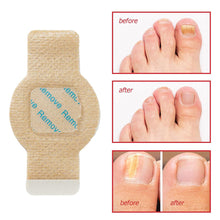 Load image into Gallery viewer, Toenail Correction Stickers Nail Repair Care Stickers Pain Relief &amp; Protection For Daily Comfort Sports &amp; Activity Protection Toe Nail Issues Nail Recovery Aid
