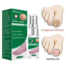 Load image into Gallery viewer, Nail Fungus Anti Infection Feet Care Essence Nails Foot Repair Toe Nail Fungal Treatment Removal Gel Paronychia Onychomycosis
