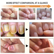 Load image into Gallery viewer, Nail Fungus Anti Infection Feet Care Essence Nails Foot Repair Toe Nail Fungal Treatment Removal Gel Paronychia Onychomycosis
