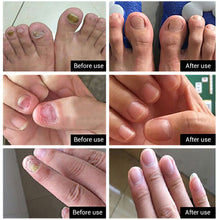 Load image into Gallery viewer, Nail Fungus Anti Infection Feet Care Essence Nails Foot Repair Toe Nail Fungal Treatment Removal Gel Paronychia Onychomycosis
