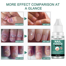 Load image into Gallery viewer, Nail Foot Toe Anti Infection Paronychia Onychomycosis Nail Fungal Treatment Feet Care Essence Nail Fungus Removal Health Care
