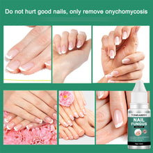 Load image into Gallery viewer, Nail Foot Toe Anti Infection Paronychia Onychomycosis Nail Fungal Treatment Feet Care Essence Nail Fungus Removal Health Care
