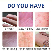 Load image into Gallery viewer, Antibacterial Psoriasis Cream Herbal Effective Relief Dermatitis Eczema Antipruritic Treatment Urticaria Desquamation Skin Care
