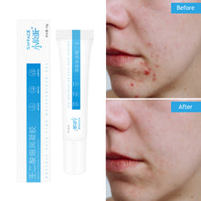 Load image into Gallery viewer, Acid Acne Cream Remove Acnes Cream Facial Skin Care Acne Scar Acne Pit Repair Mild and Non-irritating Gel Shrink Pores Gel
