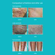 Load image into Gallery viewer, Against Psoriasis Cream Natural Herbal Ointment Antibacterial Gel Anti-Itch Eczematoid Urticaria Psoriasis Skin Care Cream
