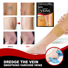 Load image into Gallery viewer, 12pcs/pack Vein Health Patch Relieves Varicose Feet Blood Vessel Blockage Cold Compress Venous Health Patch Health Care
