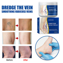 Load image into Gallery viewer, Worm Legs Varicose Vein Repair Cream Repair Vasculitis Phlebitis Massage Varicose Massage Earthworm Leg Pain Topical Cream
