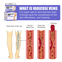 Load image into Gallery viewer, Leg Repair Cream Varicose Legs Earthworms Blue Veins Protruding Pain Pulse Health Leg Care Vasculitis Ointment Veins Relief Cream
