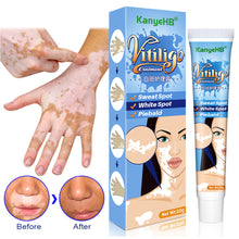 Load image into Gallery viewer, Herbal Extract Vitiligo Ointment Remove Ringworm White Spot Removal Skin White Spot Leukoplakia Disease Treatment Cream
