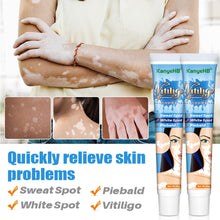 Load image into Gallery viewer, Herbal Extract Vitiligo Ointment Remove Ringworm White Spot Removal Skin White Spot Leukoplakia Disease Treatment Cream
