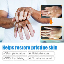 Load image into Gallery viewer, Herbal Extract Vitiligo Ointment Remove Ringworm White Spot Removal Skin White Spot Leukoplakia Disease Treatment Cream

