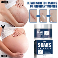 Load image into Gallery viewer, Skin Scar Gel Cream Cold Compress Burn Scar Cream Fade Surgical Scar Repair Cream Effective Acne Scar Removal Cream

