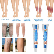 Load image into Gallery viewer, Herbal Varicose Veins Treatment Cream Relieve Tired Legs Dilated Vasculitis Phlebitis Spider Pain Relief Ointment Body Care
