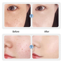 Load image into Gallery viewer, Skin Tag Remover 15 Levels Laser Plasma Pen Freckle Mole Warts Removal Lcd Nevus Tattoo Black Spots Remover Blemish Removal
