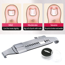 Load image into Gallery viewer, Professional Pedicure Recover Embed Toe Nail Treatment Ingrown Toenail Corrector Tools Onychia Lateralis Correction Foot Care Tool
