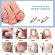 Load image into Gallery viewer, Professional Pedicure Recover Embed Toe Nail Treatment Ingrown Toenail Corrector Tools Onychia Lateralis Correction Foot Care Tool
