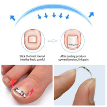 Load image into Gallery viewer, Professional Pedicure Recover Embed Toe Nail Treatment Ingrown Toenail Corrector Tools Onychia Lateralis Correction Foot Care Tool

