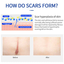 Load image into Gallery viewer, Scar Removal Cream Acne Spots Remove Burn Surgical Scar Repair Cream Smoothing Cream Treatment Hyperplastic Scar Repair Gel
