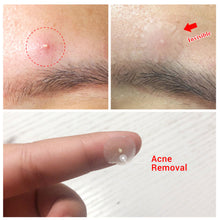 Load image into Gallery viewer, Mini Acne Pimple Patch Invisible Acne Removal Patches Acne Treatment Acne Master Pimple Remover Daily / Night Stickers
