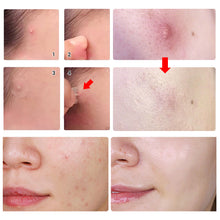 Load image into Gallery viewer, Mini Acne Pimple Patch Invisible Acne Removal Patches Acne Treatment Acne Master Pimple Remover Daily / Night Stickers
