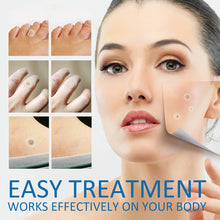 Load image into Gallery viewer, 180PCS Skin Tag Wart Remove Wart Acuminate Skin Repair Stick Acne Pimple Patch Pimple Treatments Patches Cream Warts Sticker
