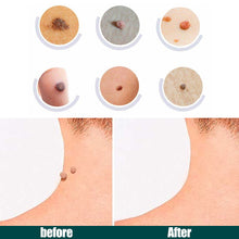 Load image into Gallery viewer, 120/240Pcs Skin Tag Remover Patches Wart Treatment Stickers Treatments Hydrocolloid Gel Acne Warts Invisible Skin Care
