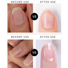 Load image into Gallery viewer, Nail Fungal Removal Treatment Essence Pen Anti Infection Paronychia Onychomycosis Nail Repair Pen Foot Toenail Gel Feet Care Repair Liquid
