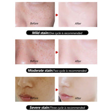 Load image into Gallery viewer, Freckles Remove Cream Melasma Remover Dark Spot Lightening Removal Moisturizing Brighten Freckle Remove Face Skin Care Cream
