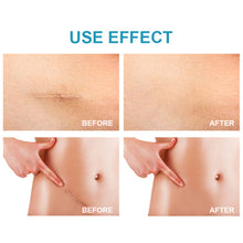 Load image into Gallery viewer, Scar Removal Cream Repair Stretch Marks Burn Acne Surgical Acne Scar Ointment Herbal Treatment Gel Whitening Beauty Health Care
