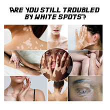 Load image into Gallery viewer, White Spot Removal Extract Vitiligo Ointment Remove Ringworm Skin White Spot Leukoplakia Disease Treatment Cream
